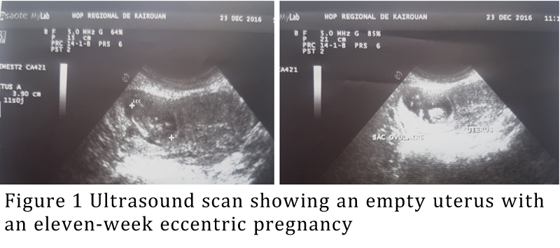 About A Case Of Failure Of Medical Treatment Of An Interstitial